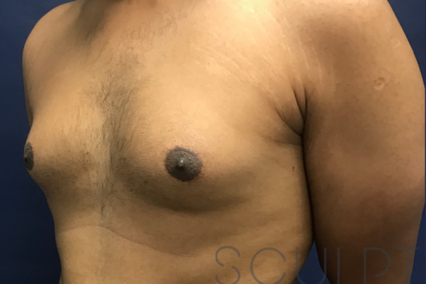 Gynecomastia Excision with Chest SCULPTing, Prosper, TX
