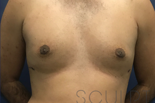 Gynecomastia Excision with Chest SCULPTing, Wylie, TX