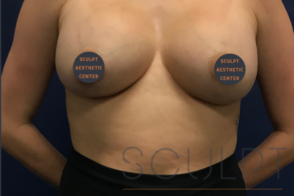 Breast Augmentation, Anna, TX