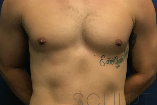 Gynecomastia Excision, Dallas, TX