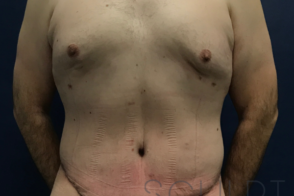 Male 360 Body Lift with Liposuction, Frisco, TX