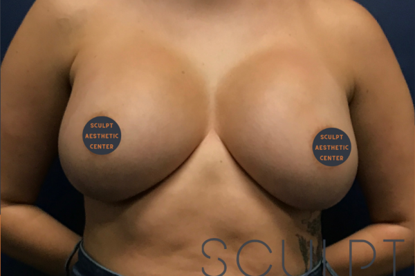 Breast Augmentation, Frisco, TX