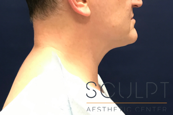 Liposuction to the Neck, Celina, TX
