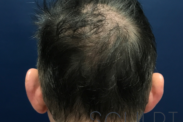 Hair Restoration, Celina, TX