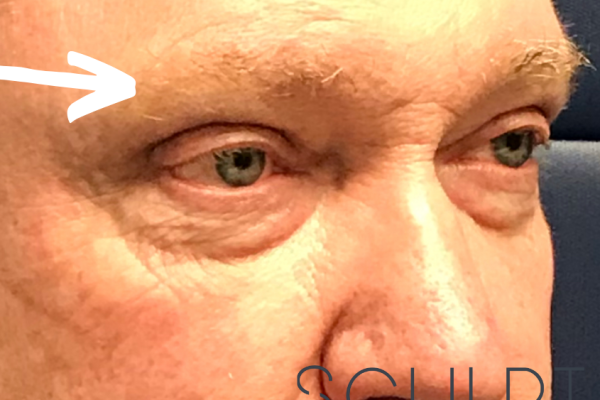 Upper Blepharoplasty, Carrollton, TX