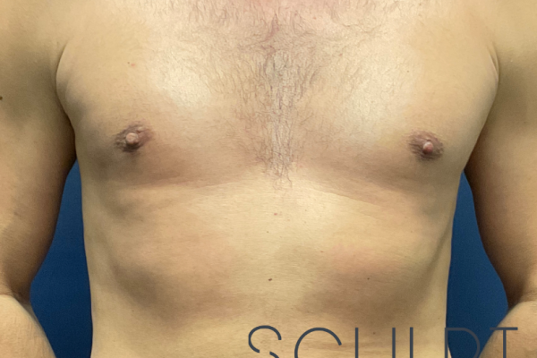 Gynecomastia Excision with Chest SCULPTing, Dallas, TX