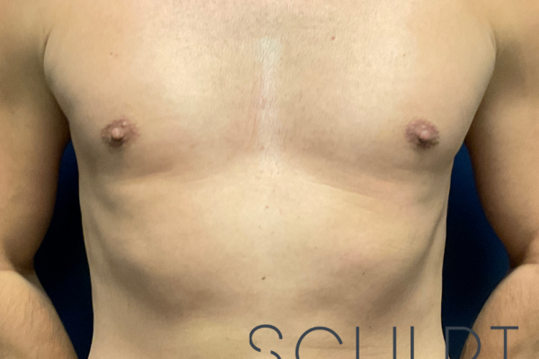 Gynecomastia Excision with Chest SCULPTing, Dallas, TX