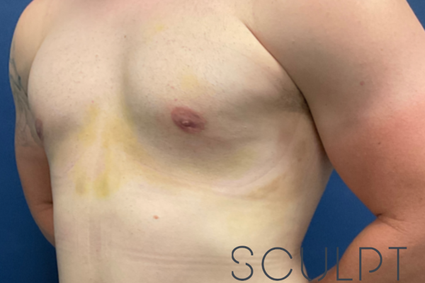 Gynecomastia Excision with Chest SCULPTing, Dallas, TX