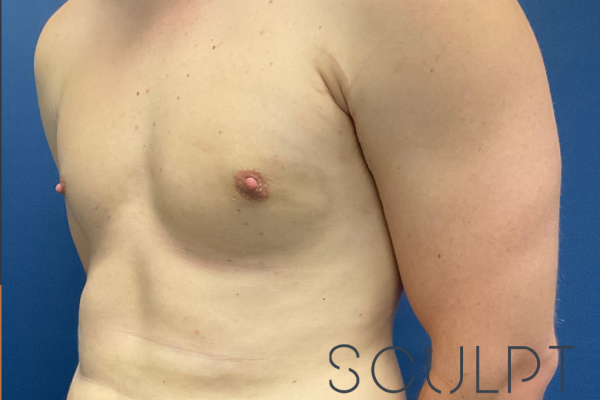 In-Office Gynecomastia Excision, Frisco, TX