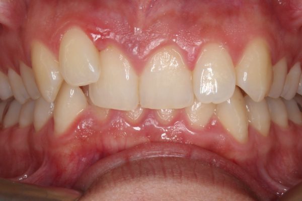 Full Treatment with Brackets